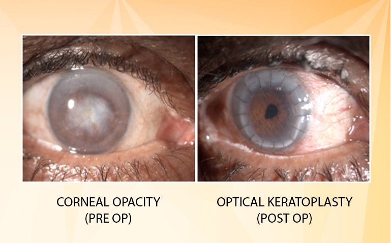 Optical Penetrating Keratoplasty (PK)