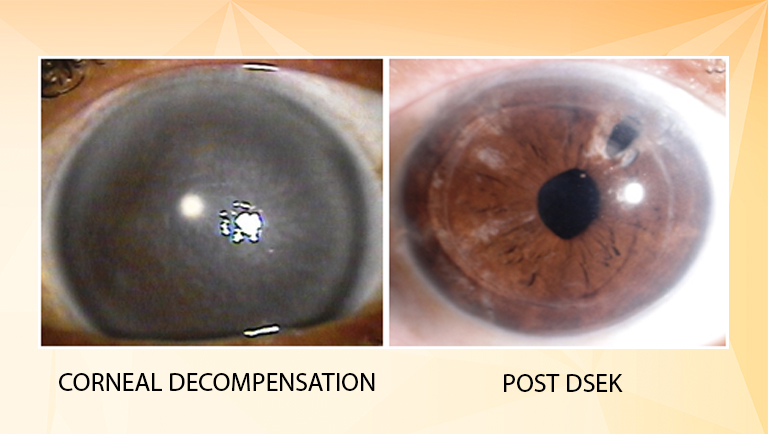 DSEK (Descemet’s Stripping Endothelial Keratoplasty)