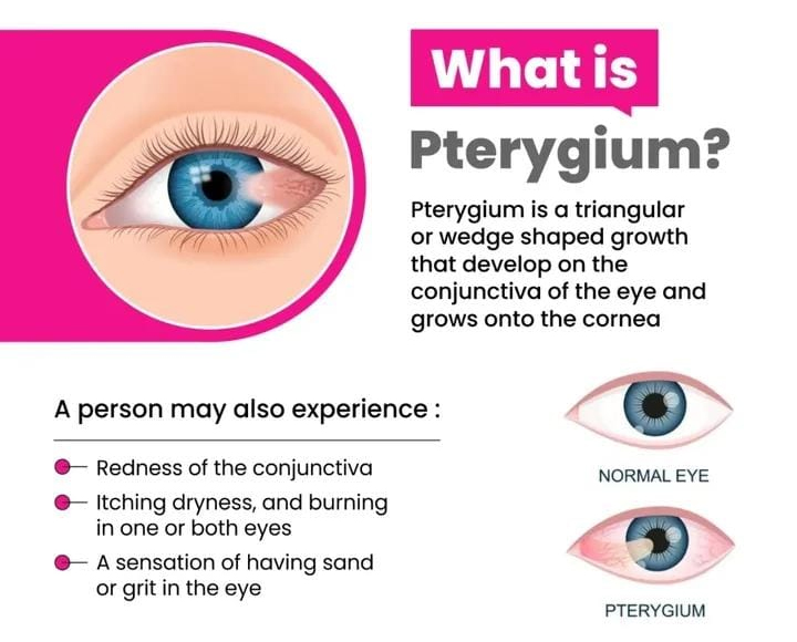 PTERYGIUM