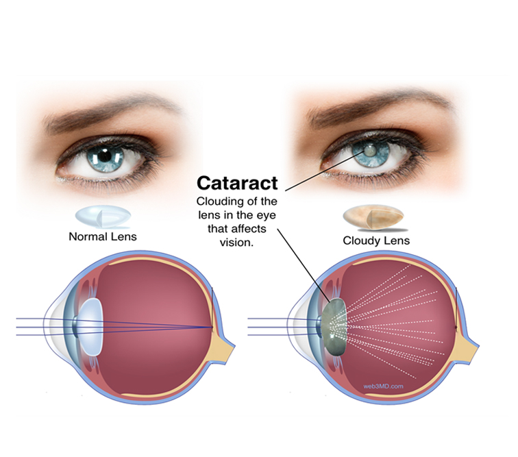 CATRACT - Minimally Invasive Advanced Cataract Surgery 
